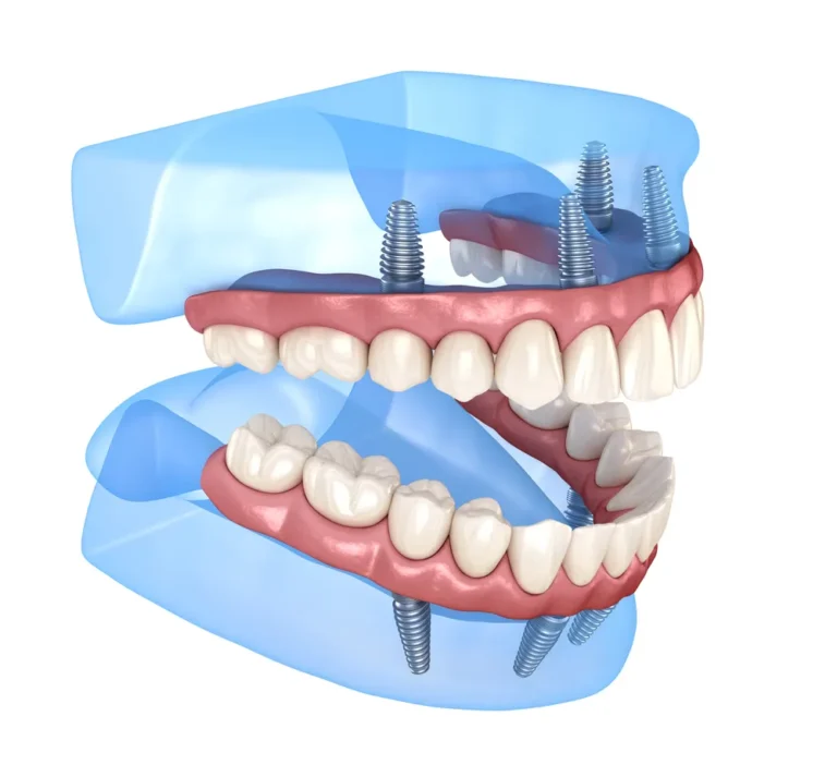 3D illustration of upper and lower All-on-4® full-mouth implants, showing full-arch prosthetics supported by four dental implants in each jaw.