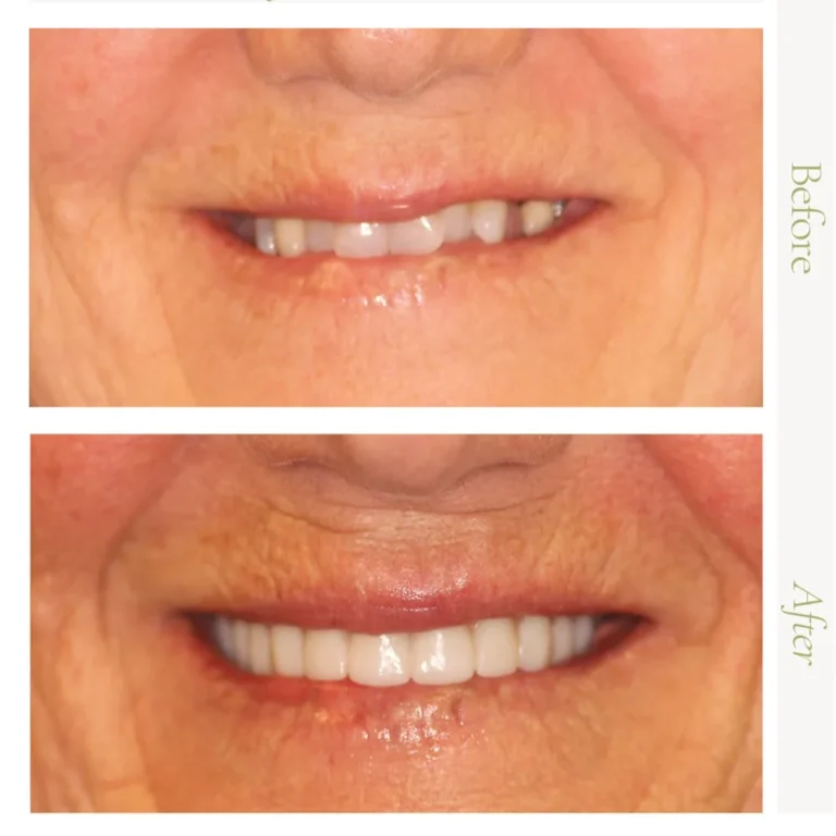 Before and after dental implants showing a full smile makeover with All-on-4 treatment in Glendale, AZ.