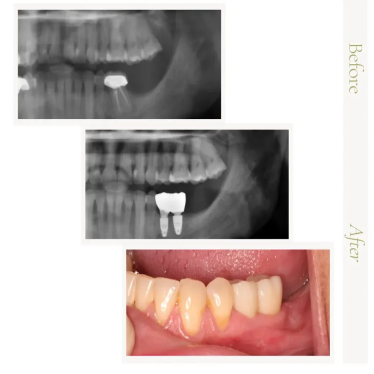 Dental implant before-and-after with X-ray and final restoration in Glendale, AZ.