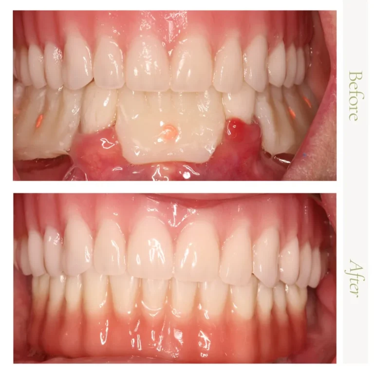 Single tooth dental implant before-and-after showing natural-looking results in Glendale, AZ.