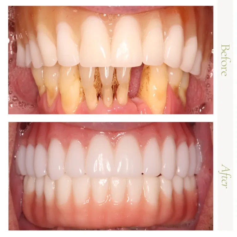 Full mouth dental implant transformation before-and-after in Glendale, AZ.