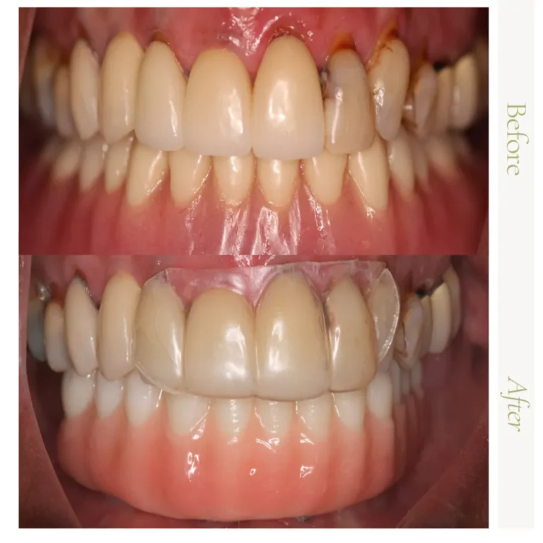 Full arch dental implant before-and-after restoration in Glendale, AZ.