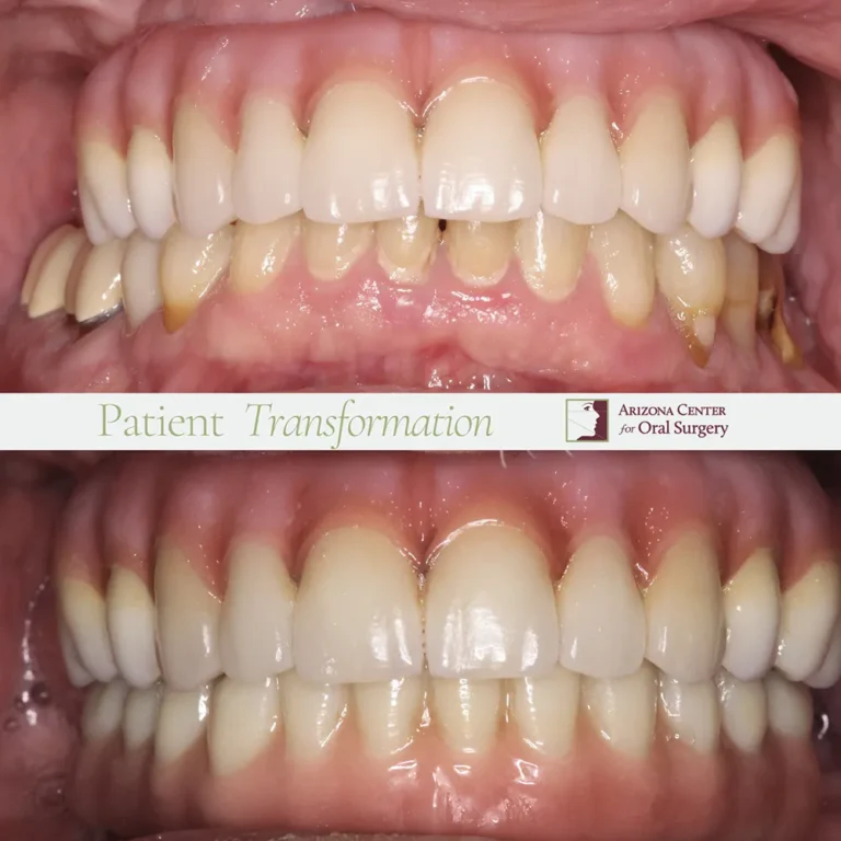 Before and after full-arch dental implant transformation at Arizona Center for Oral Surgery in Glendale, AZ.