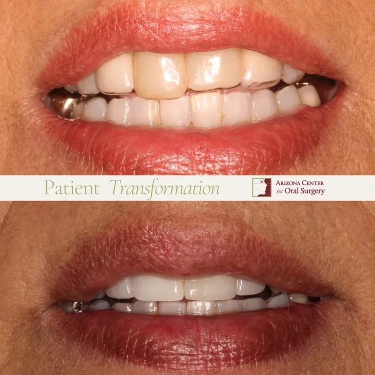 Before and after clear aligner treatment at Arizona Center for Oral Surgery in Glendale, AZ, showing improved smile alignment.