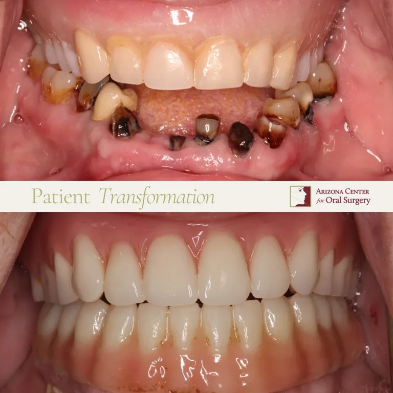 Before and after full-mouth dental implant transformation at Arizona Center for Oral Surgery in Glendale, AZ.