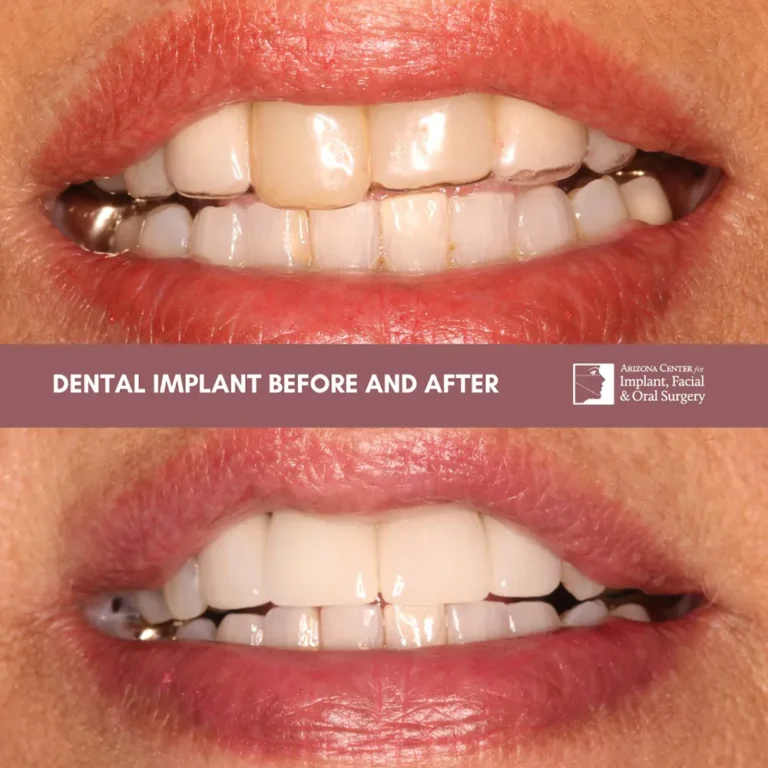 Dental implant before-and-after results at Arizona Center for Implant, Facial & Oral Surgery in Glendale, AZ.