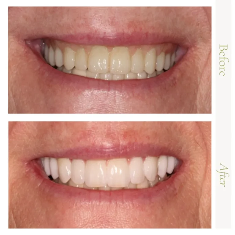 Before-and-after dental implant smile restoration at Arizona Center for Oral Surgery in Glendale, AZ.