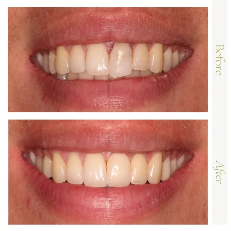 Before-and-after dental implant smile restoration at Arizona Center for Oral Surgery in Glendale, AZ.