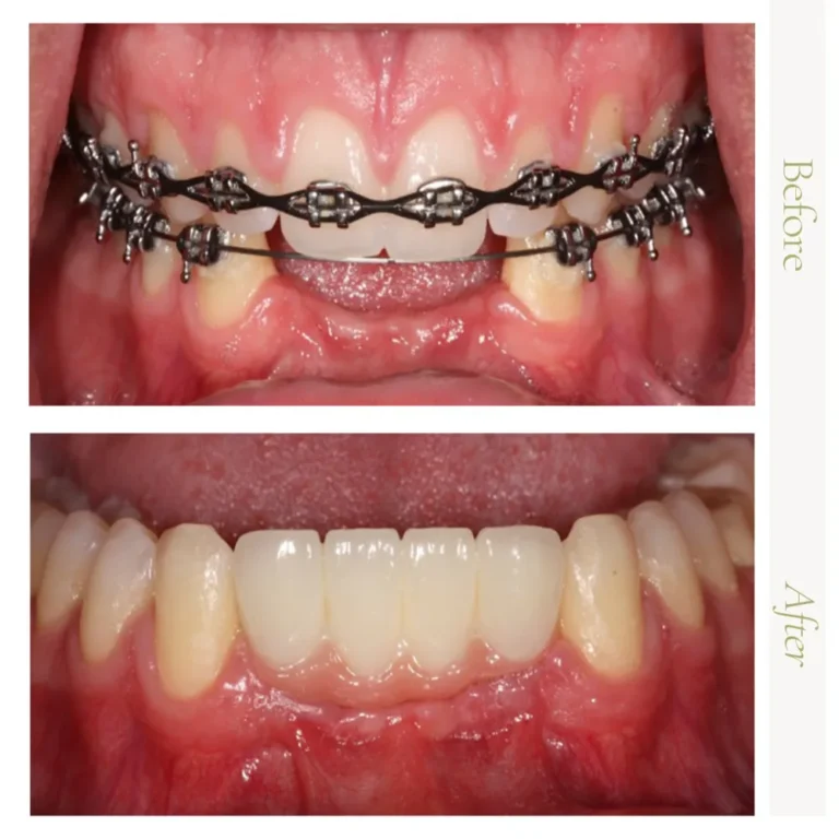 Before-and-after dental implant full mouth restoration in Glendale, AZ at Arizona Center for Oral Surgery.