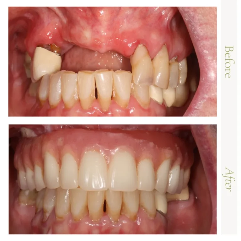 Before-and-after multiple dental implant restoration in Glendale, AZ at Arizona Center for Oral Surgery.
