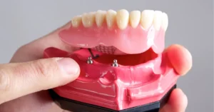 A close-up image of a hand holding a dental model showing upper dentures and lower jaw with dental implants, demonstrating how the dentures fit onto the implants.