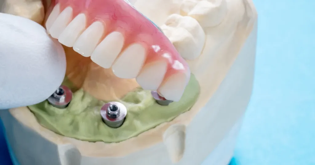 Close-up of an All-on-4 dental implant model at Arizona Center for Oral Surgery in Glendale, Arizona, demonstrating secure implant placement and full-arch restoration.