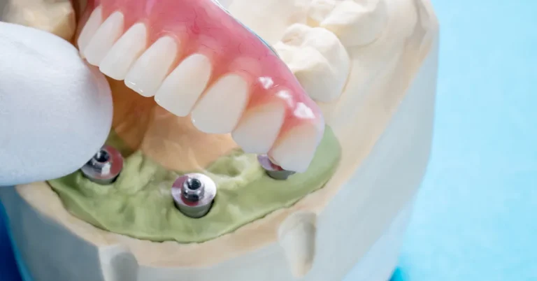 Close-up of an All-on-4 dental implant model at Arizona Center for Oral Surgery in Glendale, Arizona, demonstrating secure implant placement and full-arch restoration.