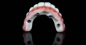 Full-arch All-on-4 dental prosthesis at Arizona Center for Oral Surgery in Glendale, Arizona, designed for secure, long-lasting smile restoration.