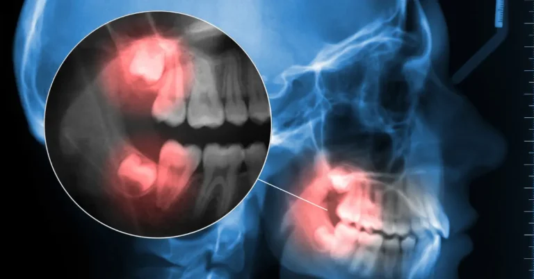 Dental X-ray showing impacted wisdom teeth beneath the gumline.